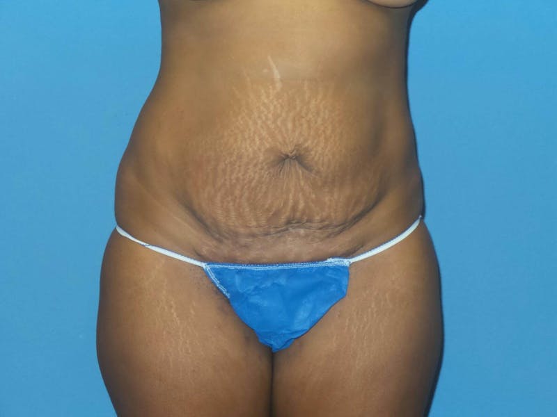 Tummy Tuck Before & After Gallery - Patient 393708 - Image 5