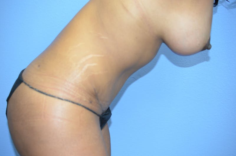 Tummy Tuck Before & After Gallery - Patient 393708 - Image 8