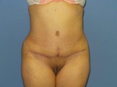 Tummy Tuck Before & After Gallery - Patient 830162 - Image 2