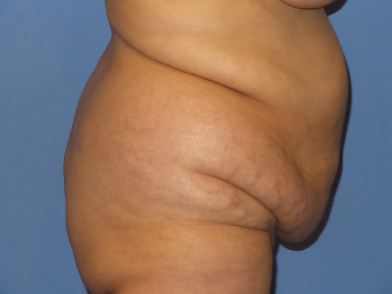 Tummy Tuck Before & After Gallery - Patient 186334 - Image 7