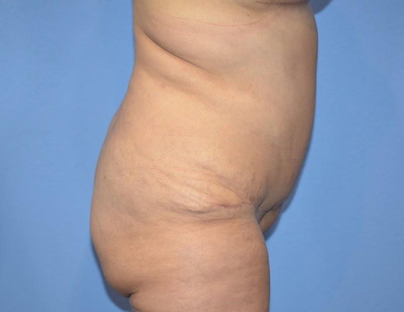 Tummy Tuck Before & After Gallery - Patient 186334 - Image 8