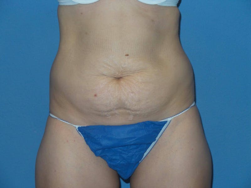 Tummy Tuck Before & After Gallery - Patient 407202 - Image 1