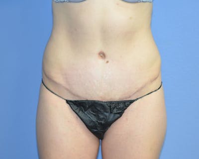Tummy Tuck Before & After Gallery - Patient 407202 - Image 2