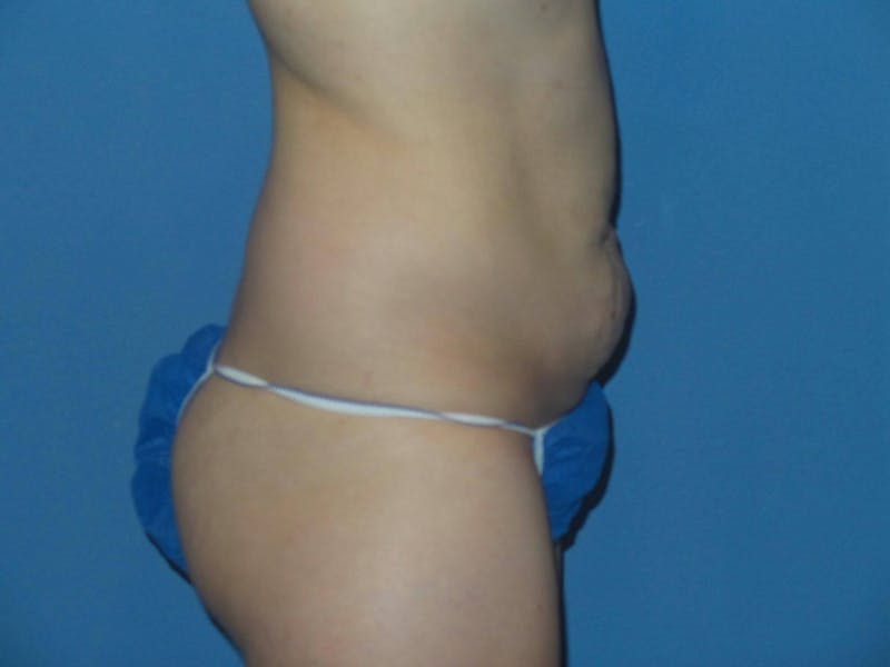 Tummy Tuck Before & After Gallery - Patient 407202 - Image 3
