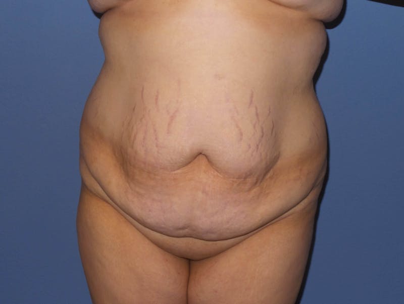 Tummy Tuck Before & After Gallery - Patient 422347 - Image 1