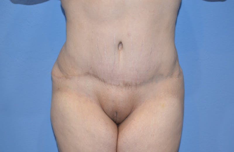 Tummy Tuck Before & After Gallery - Patient 422347 - Image 2
