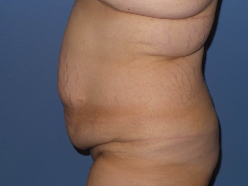 Tummy Tuck Before & After Gallery - Patient 422347 - Image 3