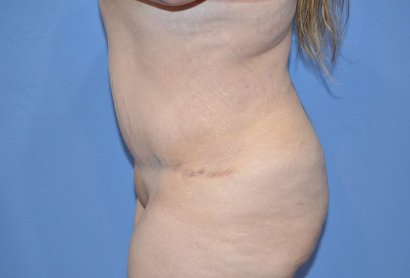 Tummy Tuck Before & After Gallery - Patient 422347 - Image 4