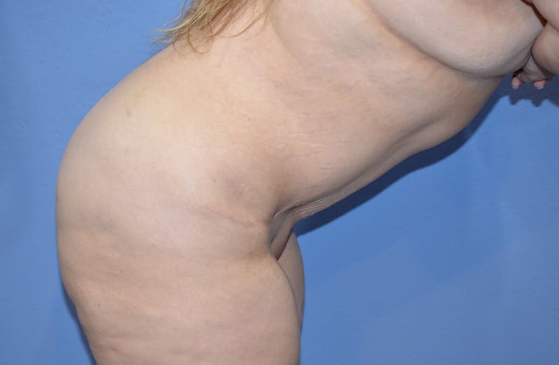 Tummy Tuck Before & After Gallery - Patient 422347 - Image 6