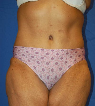 Tummy Tuck Before & After Gallery - Patient 130876 - Image 2