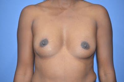Breast Augmentation Before & After Gallery - Patient 248125 - Image 1