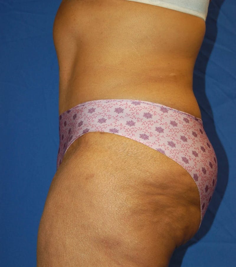 Tummy Tuck Before & After Gallery - Patient 130876 - Image 4