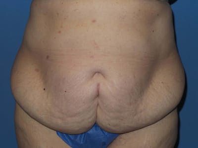 Tummy Tuck Before & After Gallery - Patient 403709 - Image 1