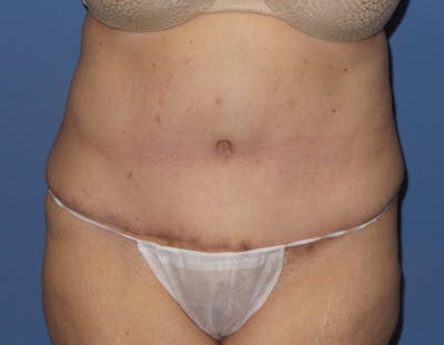 Tummy Tuck Before & After Gallery - Patient 403709 - Image 2