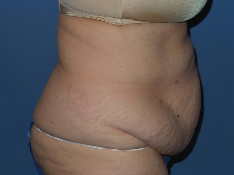 Tummy Tuck Before & After Gallery - Patient 403709 - Image 3