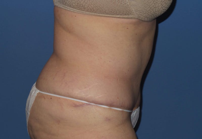 Tummy Tuck Before & After Gallery - Patient 403709 - Image 4