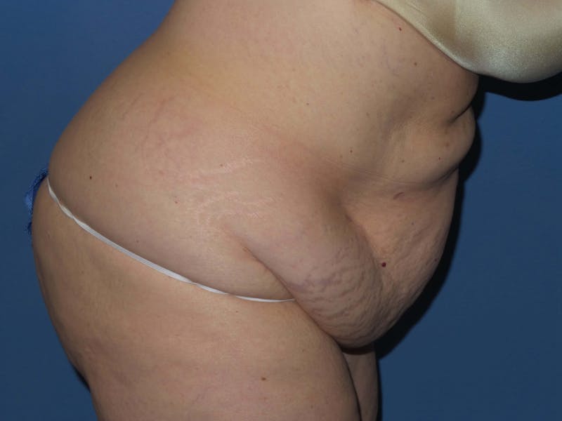 Tummy Tuck Before & After Gallery - Patient 403709 - Image 5