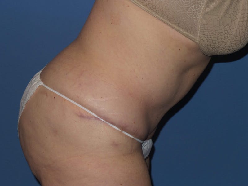 Tummy Tuck Before & After Gallery - Patient 403709 - Image 6