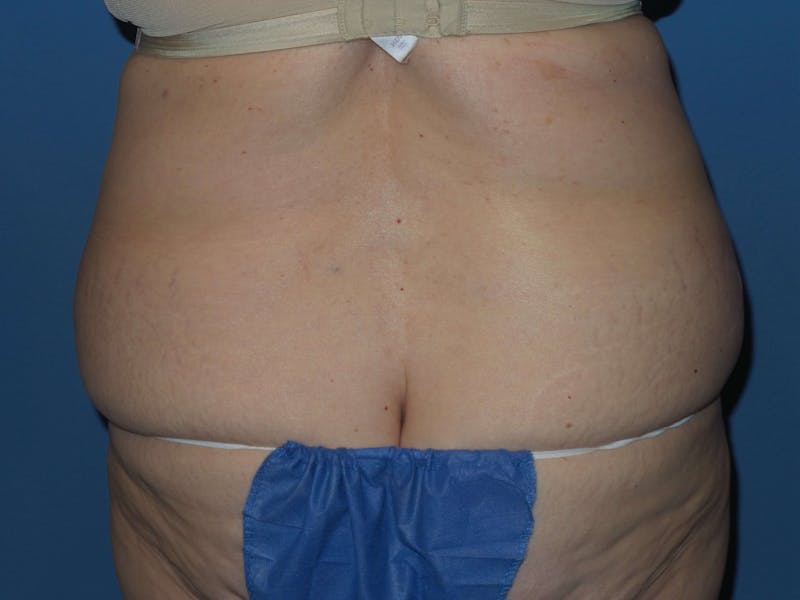Tummy Tuck Before & After Gallery - Patient 403709 - Image 7