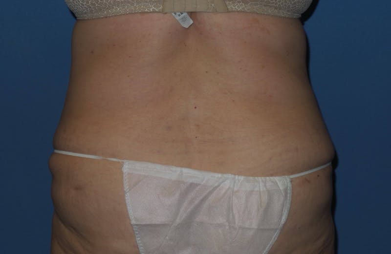 Tummy Tuck Before & After Gallery - Patient 403709 - Image 8