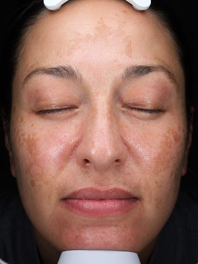 Clear + Brilliant® Before & After Gallery - Patient 200277 - Image 1