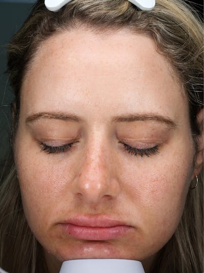 Fractora Before & After Gallery - Patient 282165 - Image 1