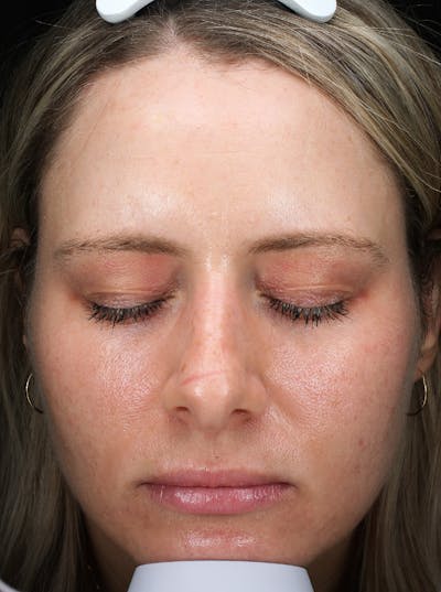 Fractora Before & After Gallery - Patient 282165 - Image 2