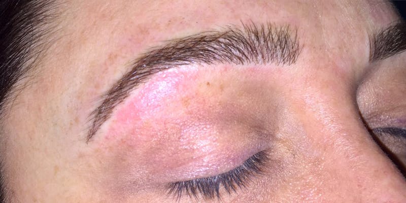 Eyebrow Microblading Before & After Gallery - Patient 644015 - Image 4