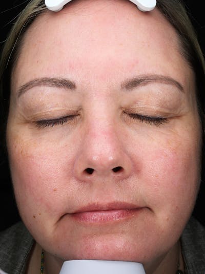Morpheus8® Before & After Gallery - Patient 130482 - Image 2