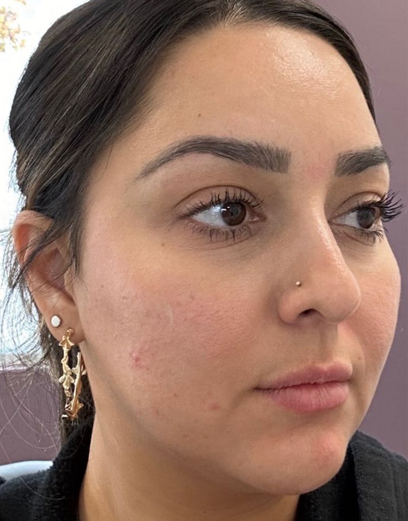 Microneedling with PRP Before & After Gallery - Patient 173877 - Image 1