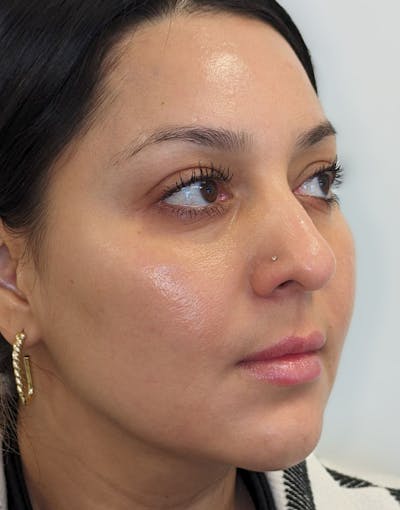 Microneedling with PRP Before & After Gallery - Patient 173877 - Image 2