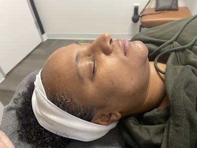SkinPen® Microneedling Before & After Gallery - Patient 124785 - Image 1