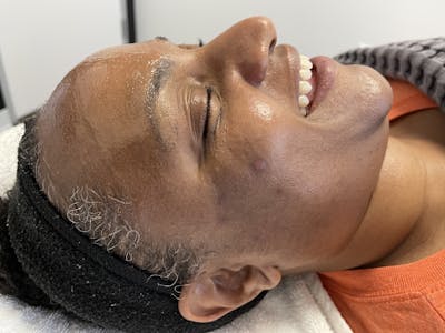 SkinPen® Microneedling Before & After Gallery - Patient 124785 - Image 2