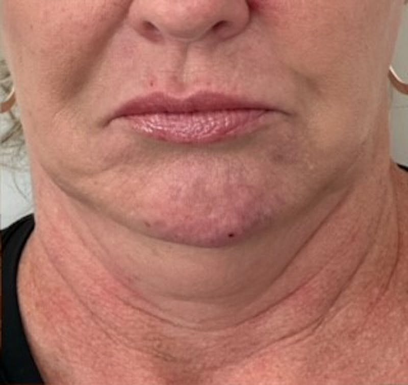 BOTOX Before & After Gallery - Patient 398191 - Image 1