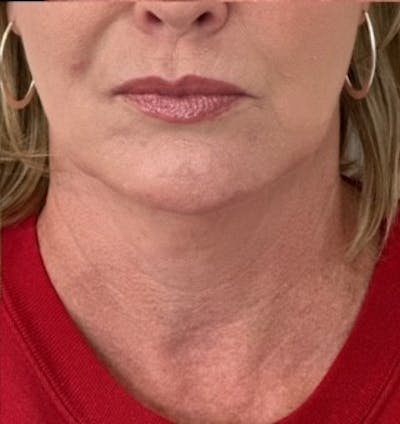 BOTOX Before & After Gallery - Patient 398191 - Image 2