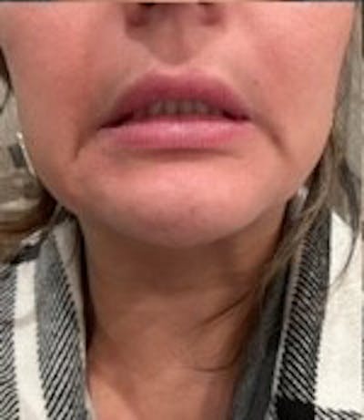 BOTOX Before & After Gallery - Patient 189608 - Image 2