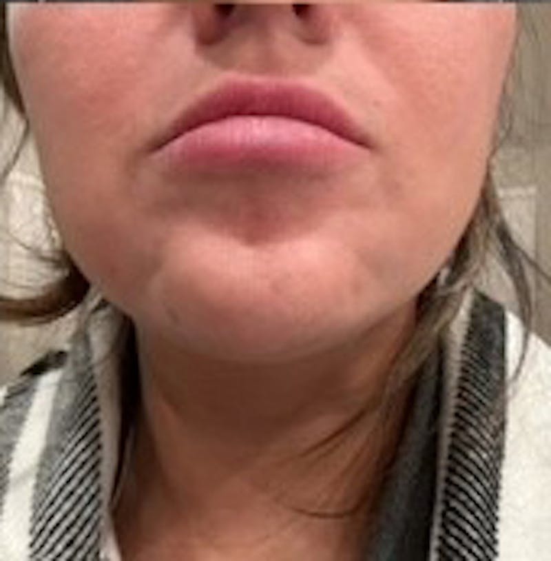 BOTOX Before & After Gallery - Patient 189608 - Image 4