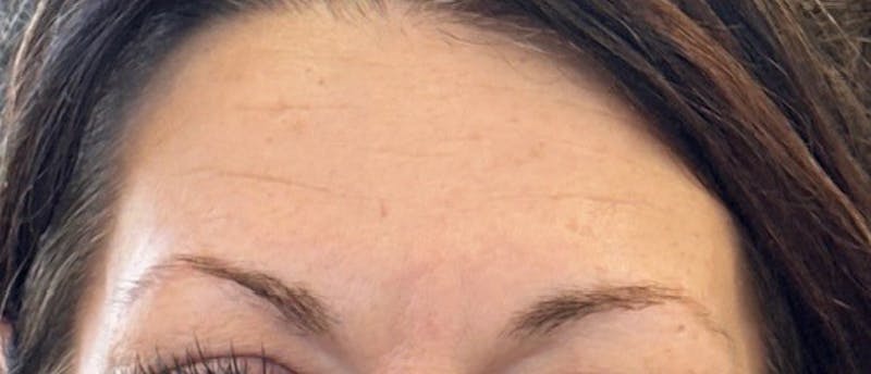 BOTOX Before & After Gallery - Patient 266060 - Image 1