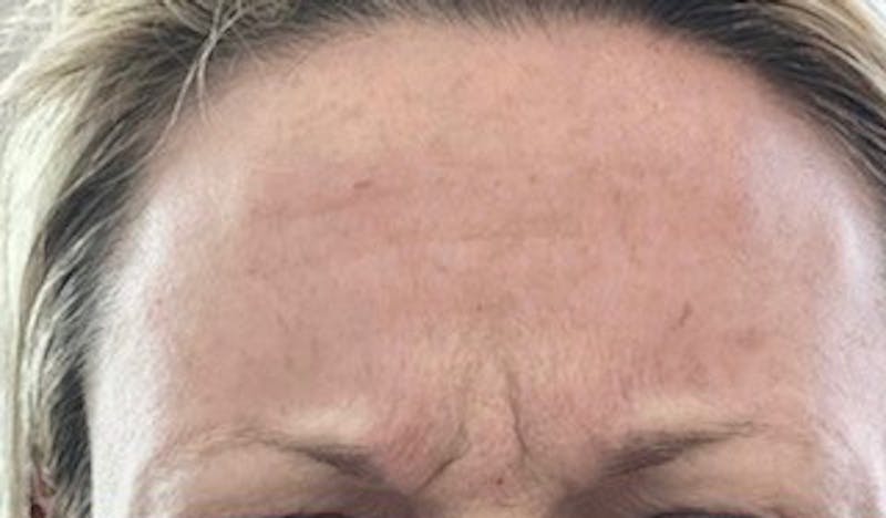 BOTOX Before & After Gallery - Patient 310470 - Image 1