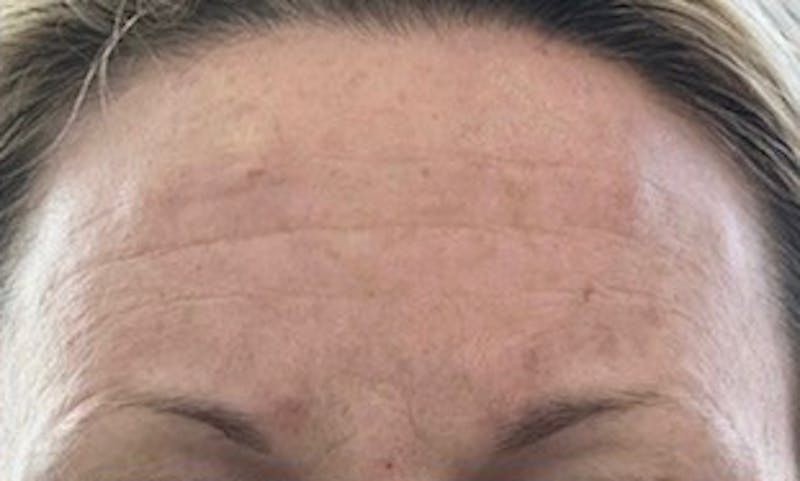 BOTOX Before & After Gallery - Patient 310470 - Image 3