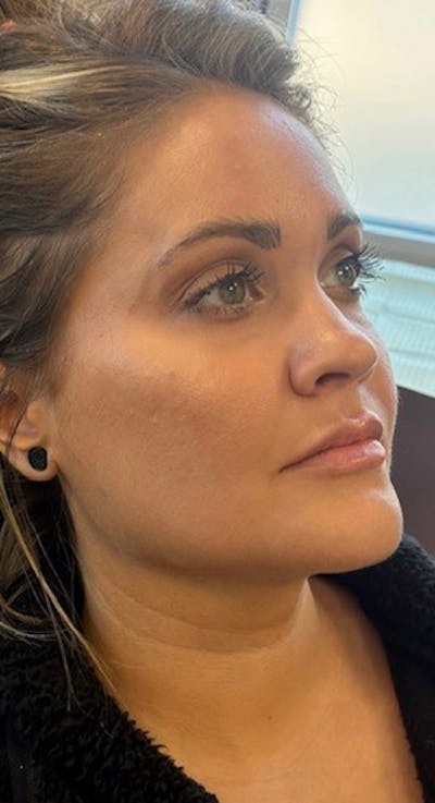 Jawline Filler Before & After Gallery - Patient 235664 - Image 2