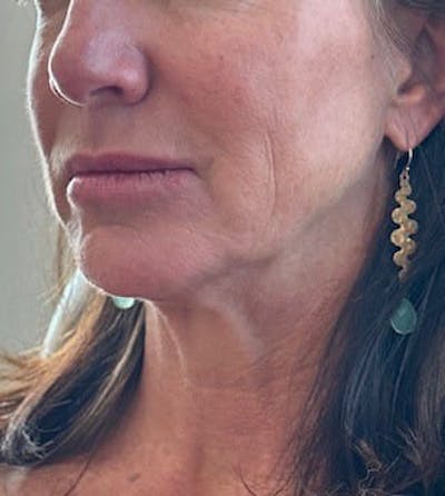 Chin Filler Before & After Gallery - Patient 116588 - Image 1
