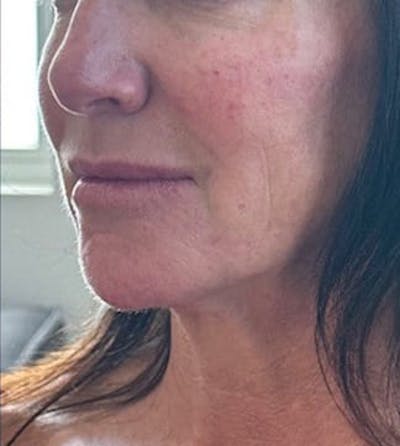 Cheek Filler Before & After Gallery - Patient 301323 - Image 2