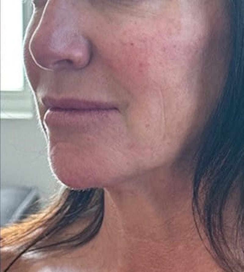 Cheek Filler Before & After Gallery - Patient 301323 - Image 2