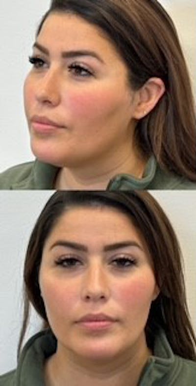 Jawline Filler Before & After Gallery - Patient 210791 - Image 1