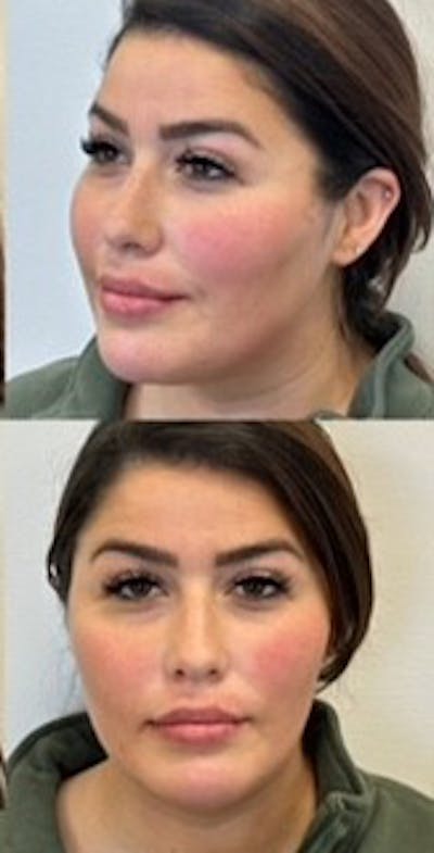 Chin Filler Before & After Gallery - Patient 375954 - Image 2