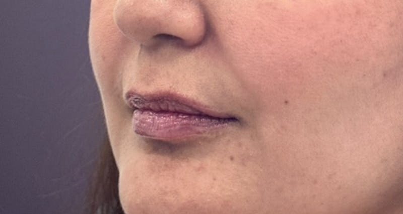 Lip Filler Before & After Gallery - Patient 157283 - Image 1