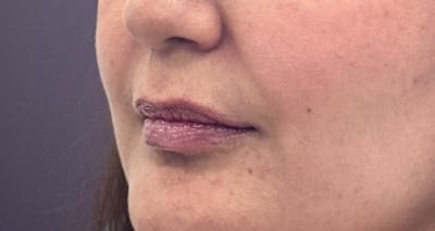 Lip Filler Before & After Gallery - Patient 157283 - Image 1