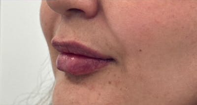 Lip Filler Before & After Gallery - Patient 157283 - Image 2