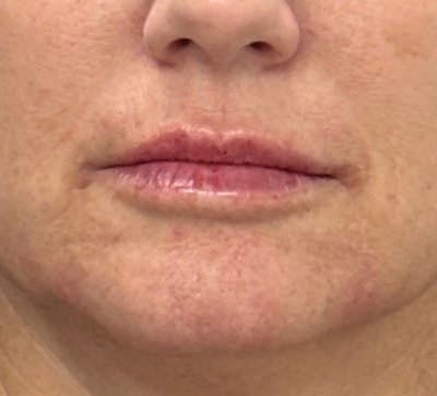 Lip Filler Before & After Gallery - Patient 397601 - Image 2